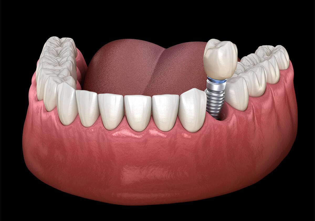 Affordable Dental Implants in Los Alamitos Area